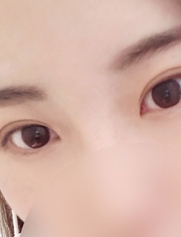韩国yellow单眼皮进行双眼皮手术对比照_术后