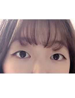 -韩国yellow自然流畅双眼皮手术60天恢复照