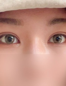 -韩国yellow双眼皮+上眼提肌矫正案例