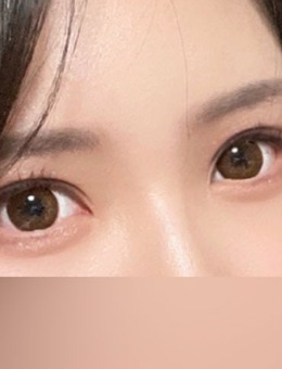 韩国yellow整形眼综合手术对比照