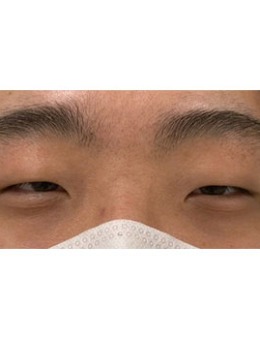 韩国fact真实整形外科男士眼整形+眼提肌手术对比照_术前