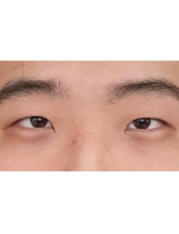 韩国fact真实整形外科男士眼整形+眼提肌手术对比照