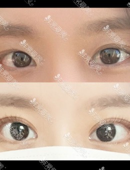 韩国icon整形三重埋线双眼皮手术对比照_术前