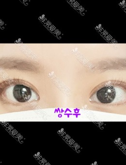 韩国icon整形三重埋线双眼皮手术对比照_术后