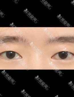 -韩国icon整形埋线双眼皮对比照片