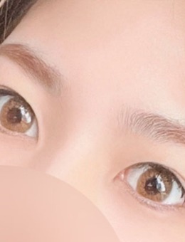 韩国yellow双眼皮+开眼角术后恢复30天照片_术前