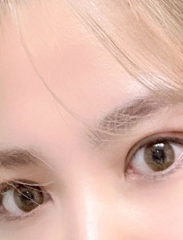 韩国yellow双眼皮+开眼角术后恢复30天照片_术后