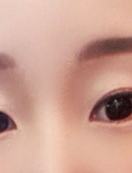 -韩国yellow整形切开法双眼皮+眼尾下至对比案例
