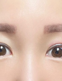 韩国yellow整形切开法双眼皮+眼尾下至对比案例_术后