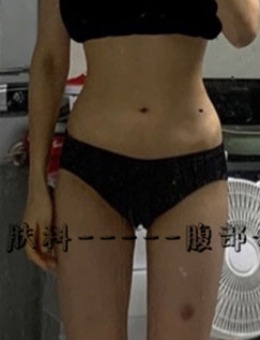 韩国Ucanb腰腹+大腿吸脂手术对比照