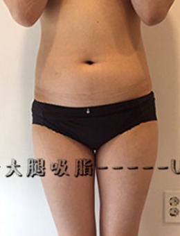 韩国Ucanb腰腹+大腿吸脂手术对比照