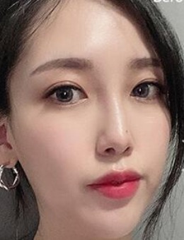 韩国爱她整形隆鼻失败修复手术照片分享