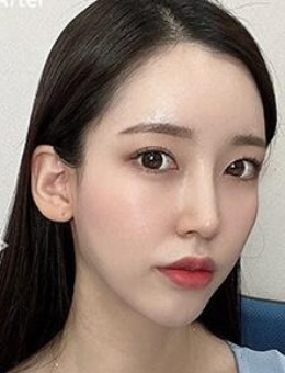 韩国爱她整形隆鼻失败修复手术照片分享