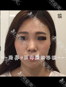 韩国UCANB整形外科隆鼻+面部脂肪填充前真人对比_术前