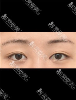 -韩国icon整形埋线双眼皮修复对比示例