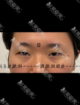 -韩国UCANB整形外科提肌+双眼皮前后“换人”对比！