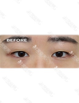 -韩国靠谱的眼部修复医院做上睑下垂矫正很厉害！