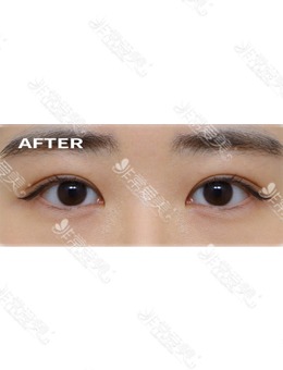 韩国靠谱的眼部修复医院做上睑下垂矫正很厉害！_术后