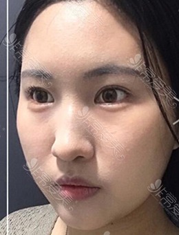 -韩国爱她整形面部吸脂+玻尿酸丰唇治疗展示结果！