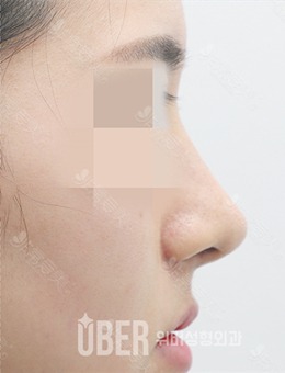 韩国玉芭无假体隆鼻+鼻翼缩小前后对比图分享，疗效靠谱！_术后