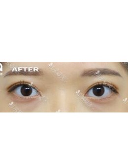 韩国爱她整形外科双眼皮手术前后对比