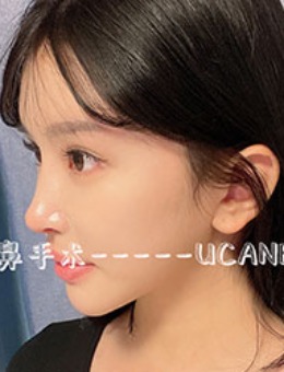 韩国Ucanb整形隆鼻手术对比照