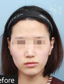 -韩国snow整形全脸自体脂肪填充对比案例