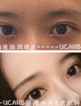 韩国Ucanb自然黏连法双眼皮手术对比照_术前