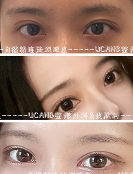 -韩国Ucanb自然黏连法双眼皮手术对比照