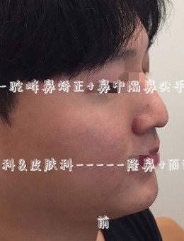 -韩国Ucanb整形男士驼峰鼻矫正+综合隆鼻手术对比照