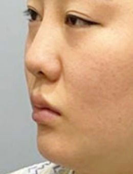 -韩国dr朵面部吸脂+双下巴下颌缘吸脂手术对比照