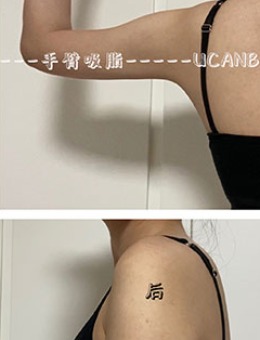 韩国Ucanb瘦手臂吸脂对比照片