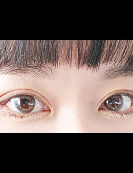 韩国icon整形三重埋线修复双眼皮手术对比照