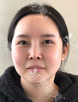 -韩国芙莱思脸部吸脂手术全过程图片记录