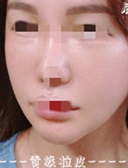 -拉皮手术对比照片曝光，韩国Ucanb整形施术分享！