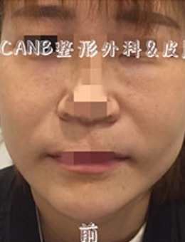 脸部拉皮手术过程图对比分享，鼻唇沟嘴角皱纹统统消失不见！_术前