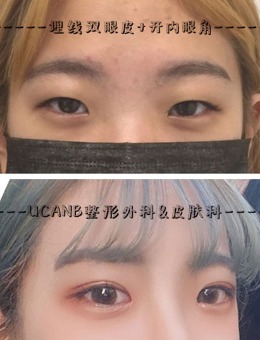 韩国Ucanb整形埋线双眼皮开眼角手术恢复对比照