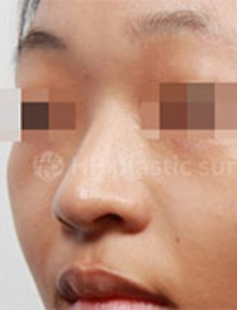 韩国HB整形隆鼻手术对比照片_术前