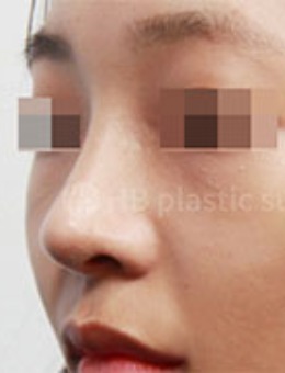 韩国HB整形隆鼻手术对比照片_术后