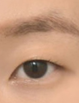 韩国icon非切开眼肌矫正+后眼角+下眼角手术对比照_术前