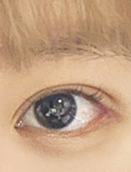 韩国icon非切开眼肌矫正+后眼角+下眼角手术对比照_术后