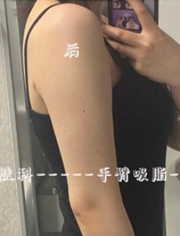 韩国Ucanb手臂吸脂恢复过程对比照图
