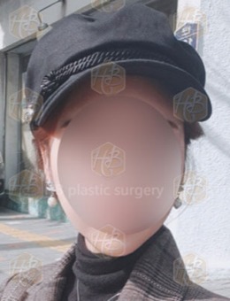 韩国HB整形贴发耳矫正手术对比照