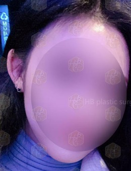 -韩国HB整形贴发耳矫正手术对比照