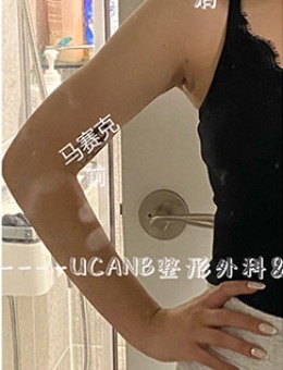 韩国Ucanb整形胳膊吸脂恢复图