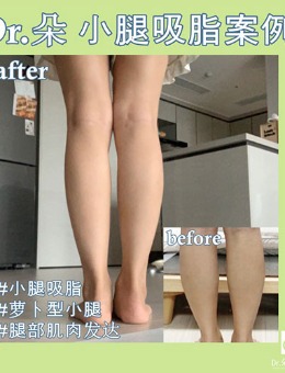 韩国dr朵小腿吸脂前后对比案例效果图_术后