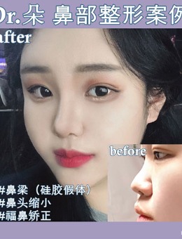 韩国dr朵小翘鼻侧脸图片分享 原来隆鼻真的可以“脱俗”_术前