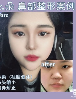 韩国dr朵小翘鼻侧脸图片分享 原来隆鼻真的可以“脱俗”_术后