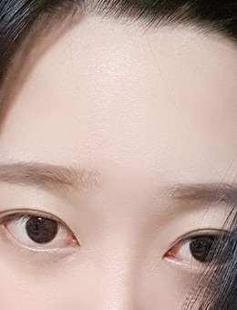 韩国yellow埋线双眼皮+填充眼皮下脂肪对比照片