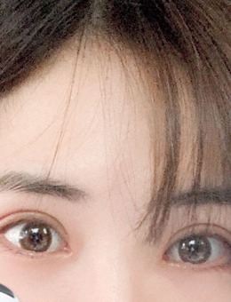 韩国yellow整形双眼皮手术20~30天恢复图_术后